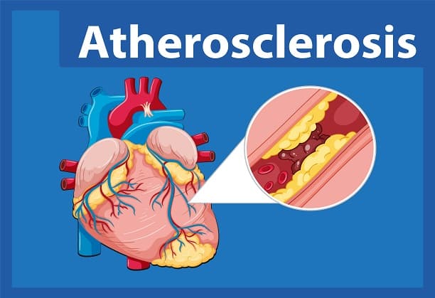 Exploring the Role of Ultrasound Contrast Agents in the Early-Stage Detection of Atherosclerosis