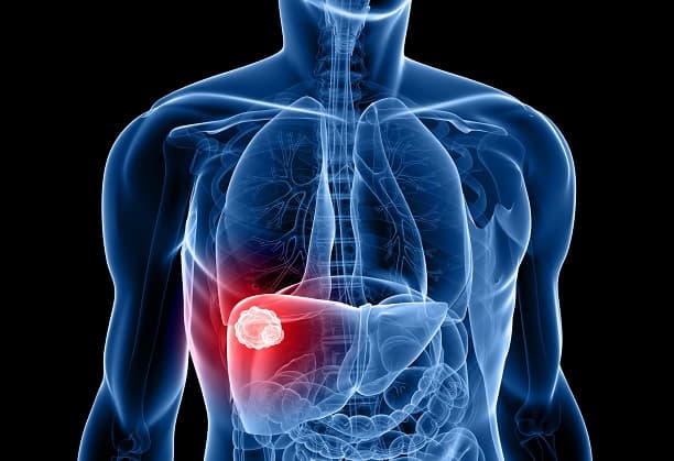 CSR Proposal on Liver Cancer Genomics